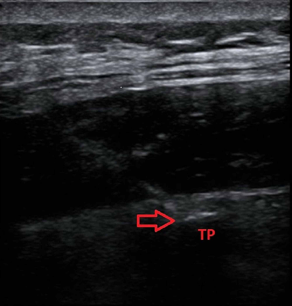 Erector-spinae-plane-block-with-ultrasound