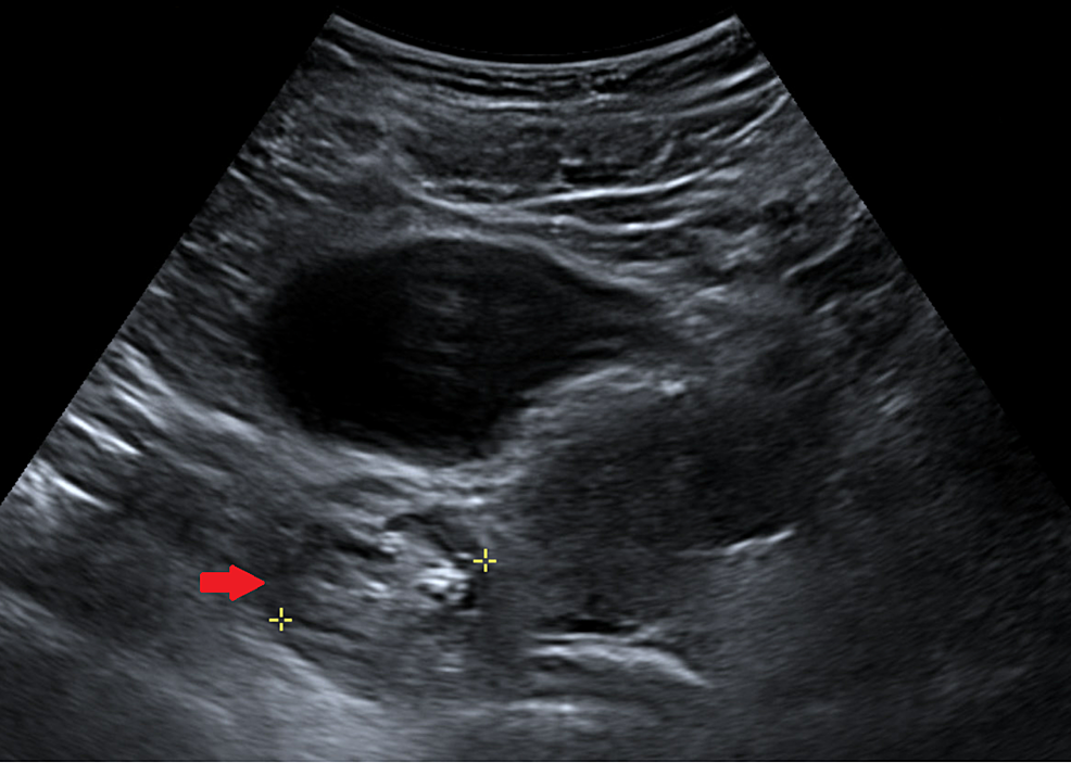 post void bladder volume normal