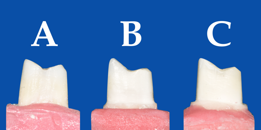 Fracture Resistance of Endodontically Treated Teeth Prepared