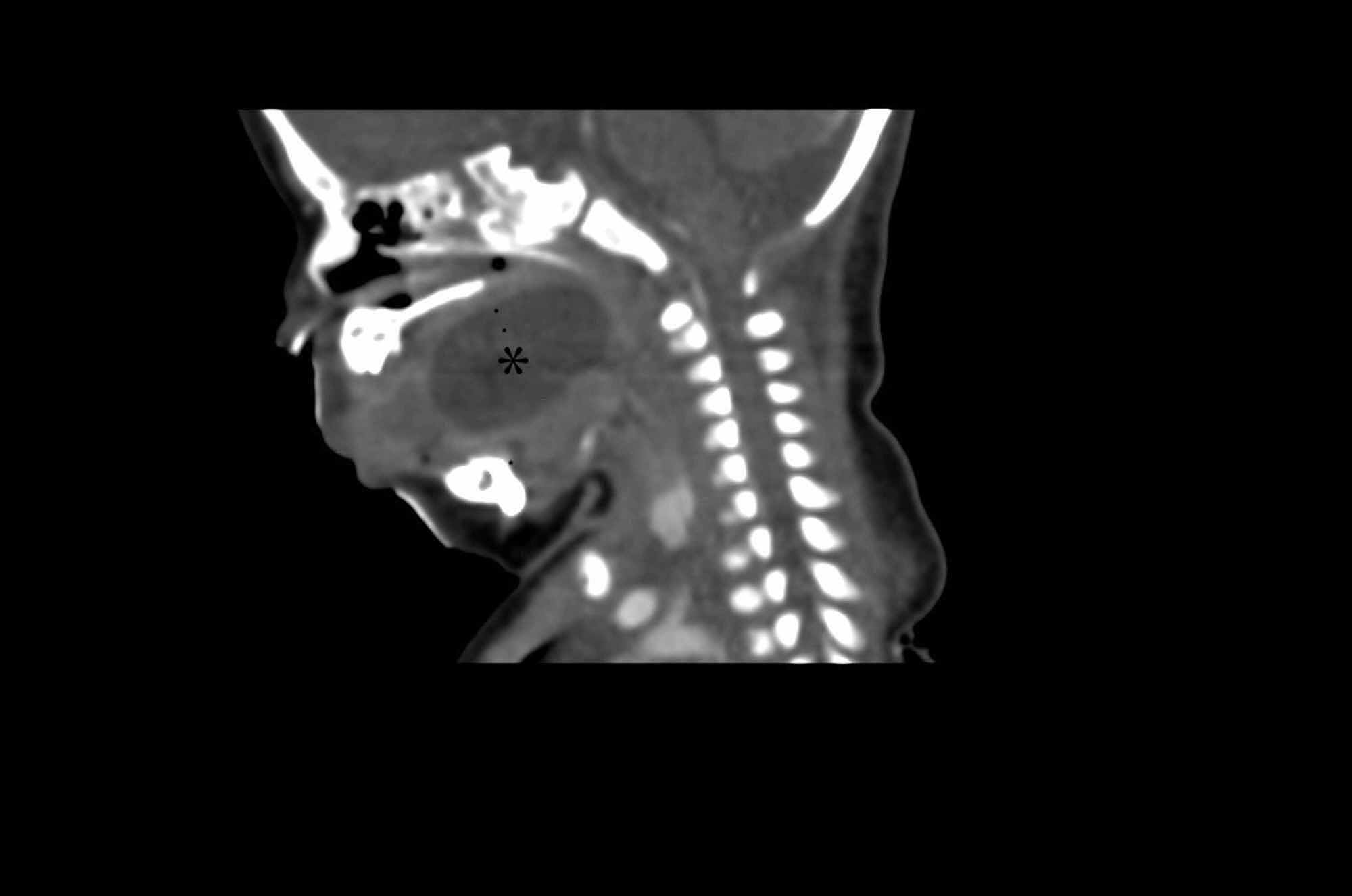 cureus-tongue-cyst-in-a-neonate-unusual-presentation