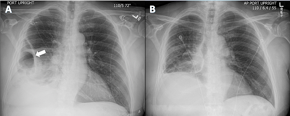 Cureus An Unusual Case Of Cavitary Lung Lesion And A Brief Review Of Literature