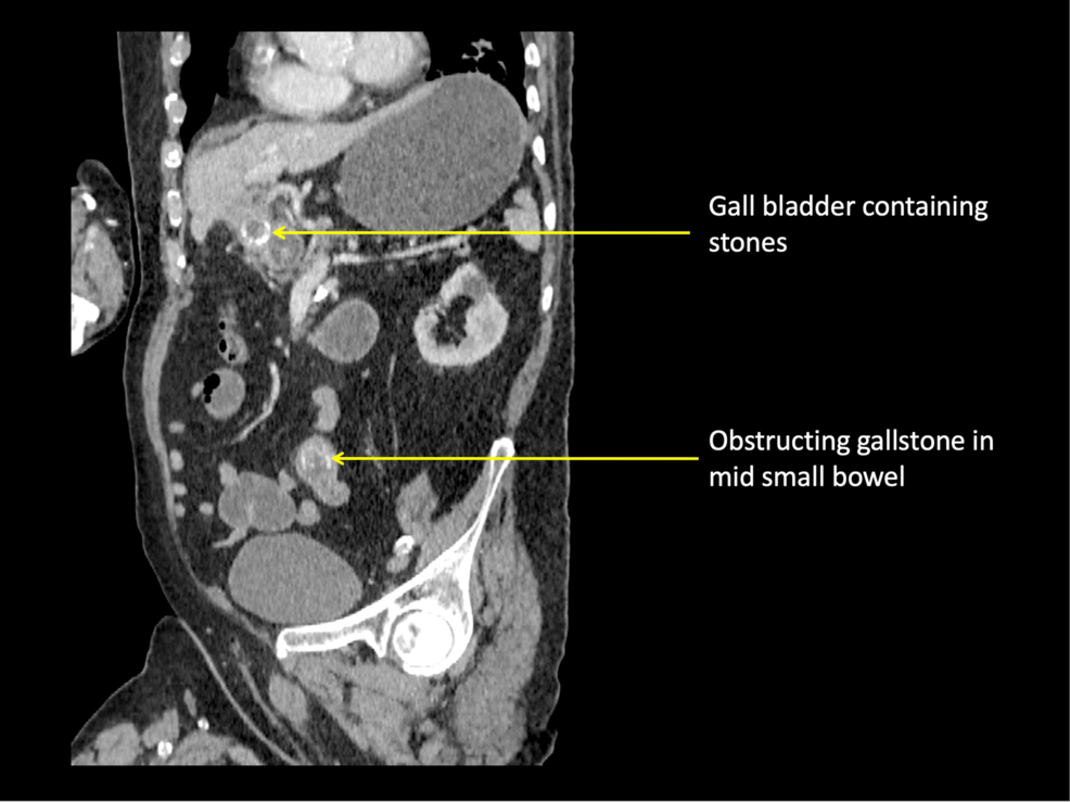 tirzepatide gallstones reddit Gall Stone Ileus and Recurrence: Management Dilemma for the Operating  Surgeon