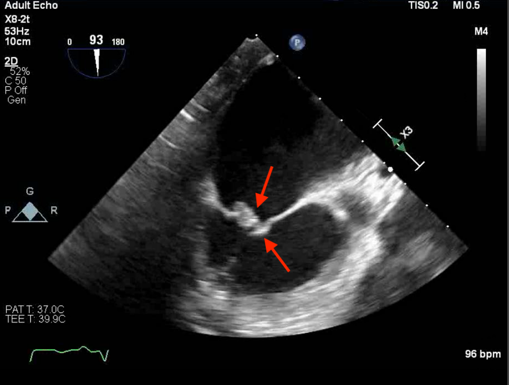 Endocarditis