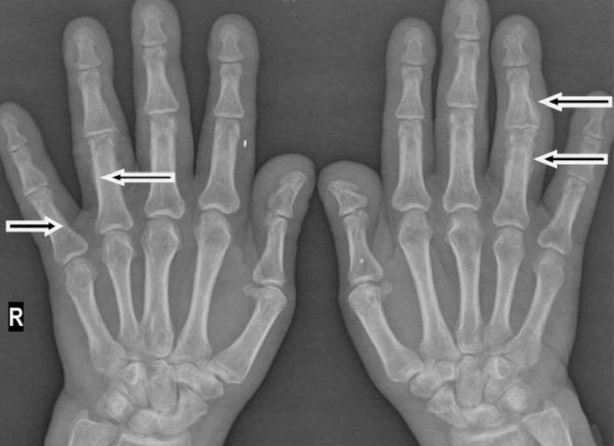 Cureus | Hypertrophic Osteoarthropathy Presenting as Rheumatoid ...