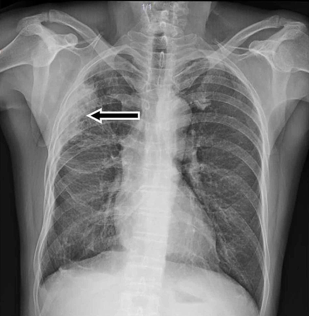 Cureus | Hypertrophic Osteoarthropathy Presenting as Rheumatoid ...