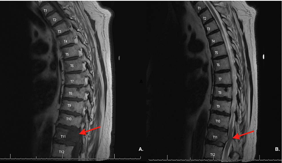 Cureus | A Grade I Intracranial Meningioma with Metastasis to Multiple ...