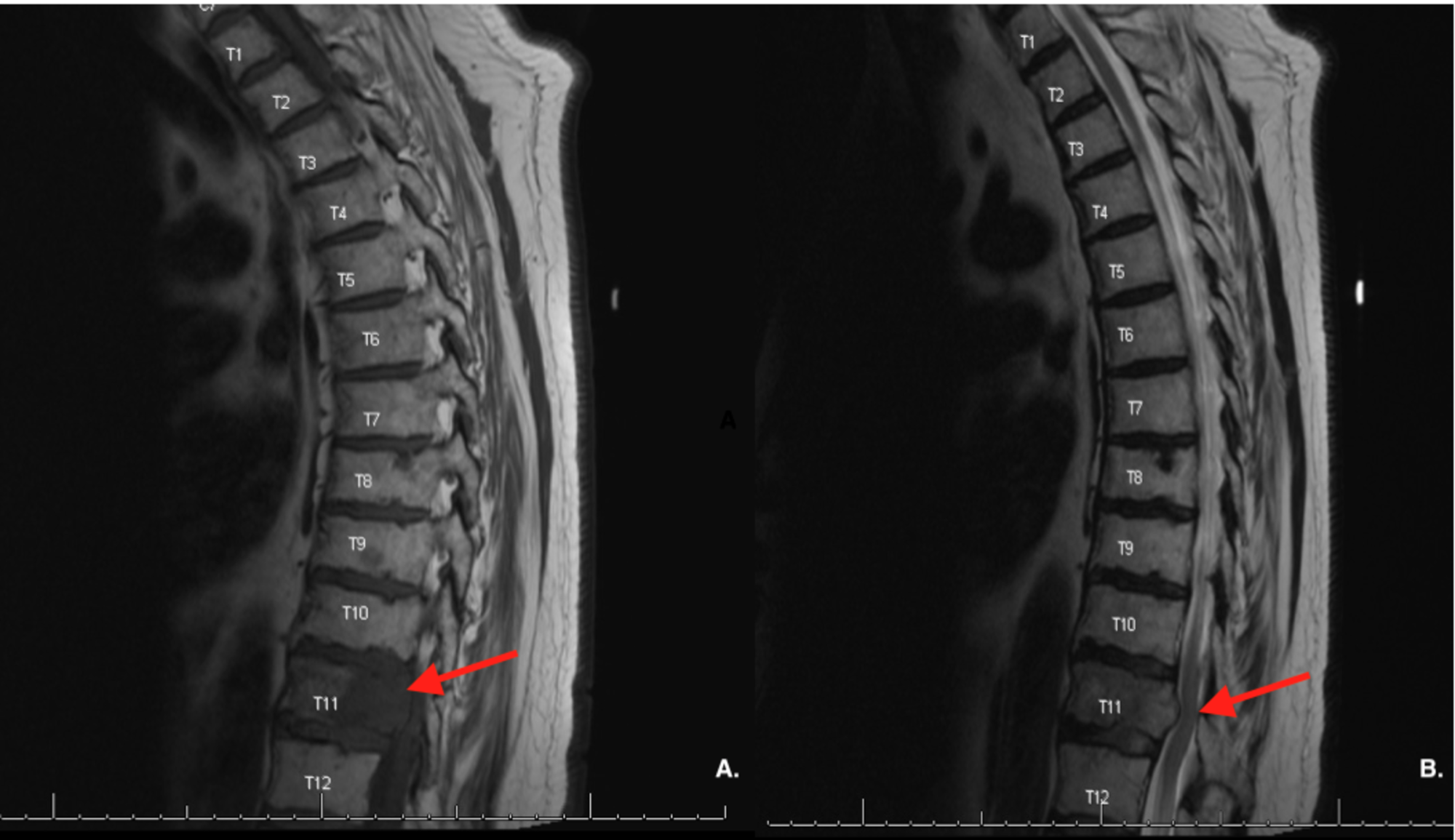 cureus-a-grade-i-intracranial-meningioma-with-metastasis-to-multiple