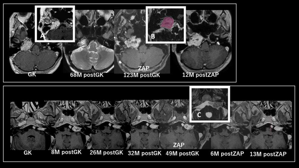 Zap-X Radiosurgery System: Initial Clinical Experience in a
