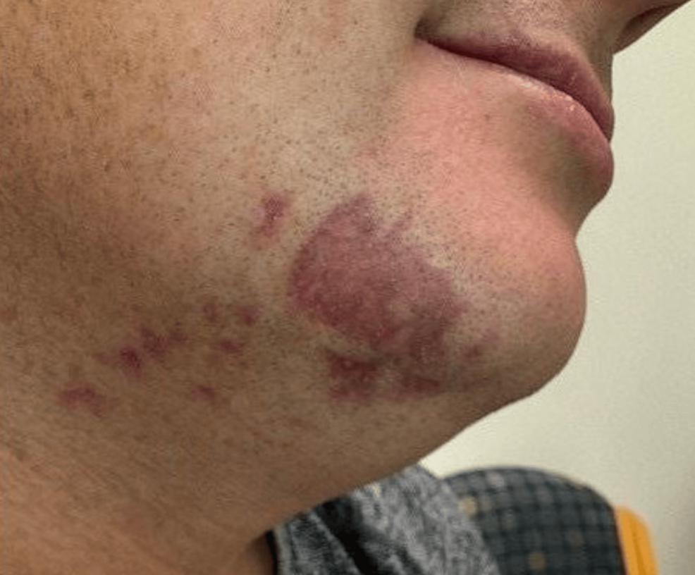 lupus and semaglutide From Prescription to Predicament: A Case of Semaglutide-Induced Discoid  Lupus Erythematosus in an Adult Male Patient