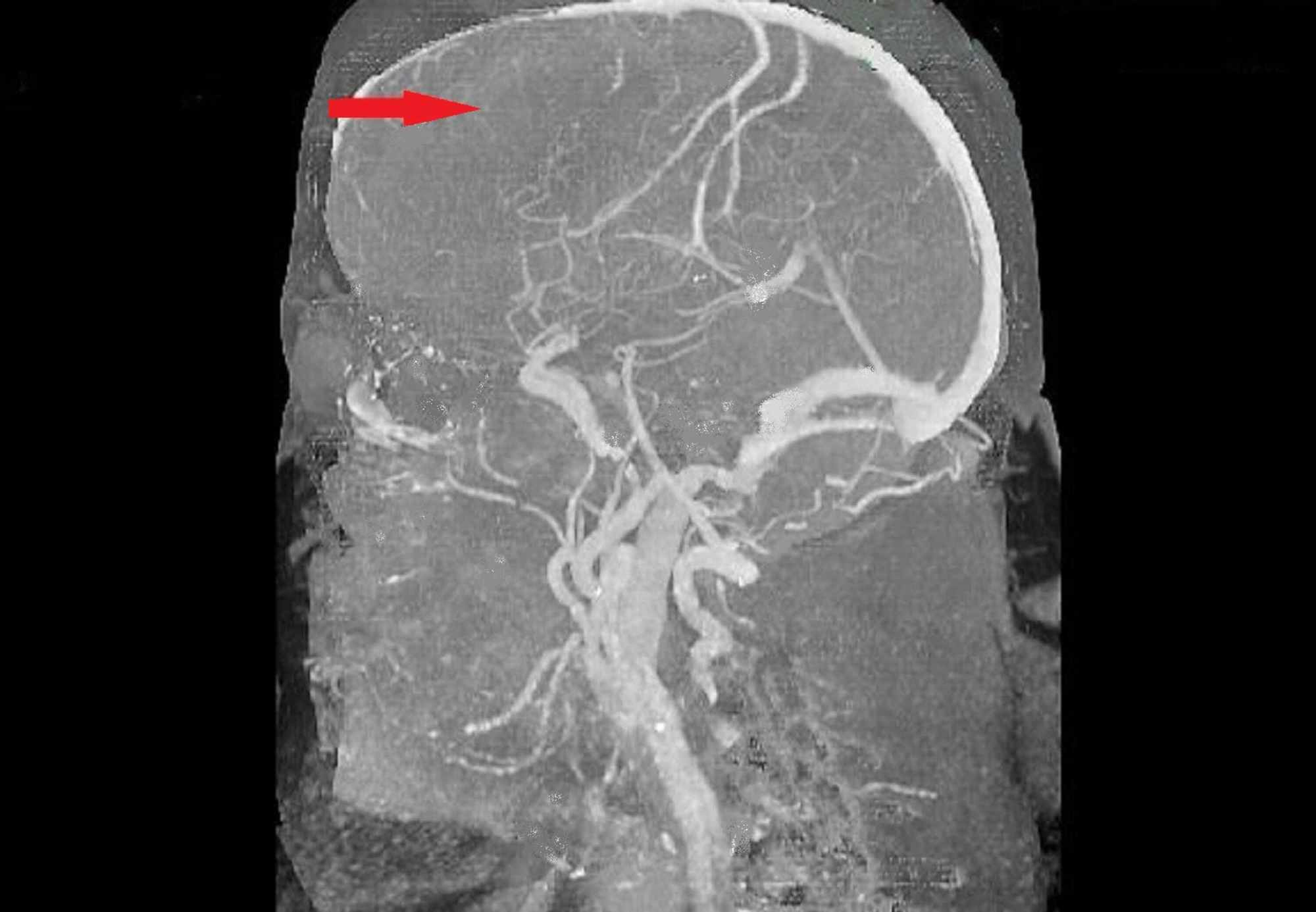 Cureus | An Interesting Case of Moyamoya Disease, a Rare Cause of ...