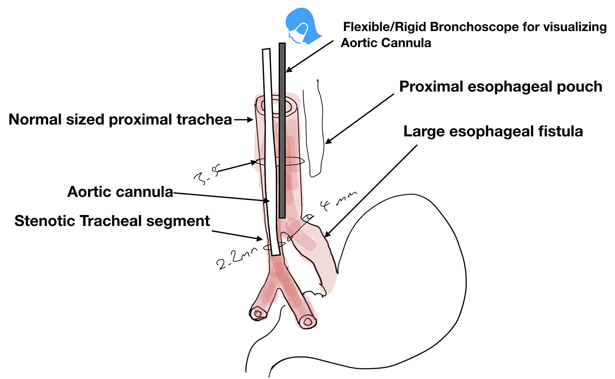 Cureus Use of an Aortic Cannula for Tracheal Intubation in a Patient