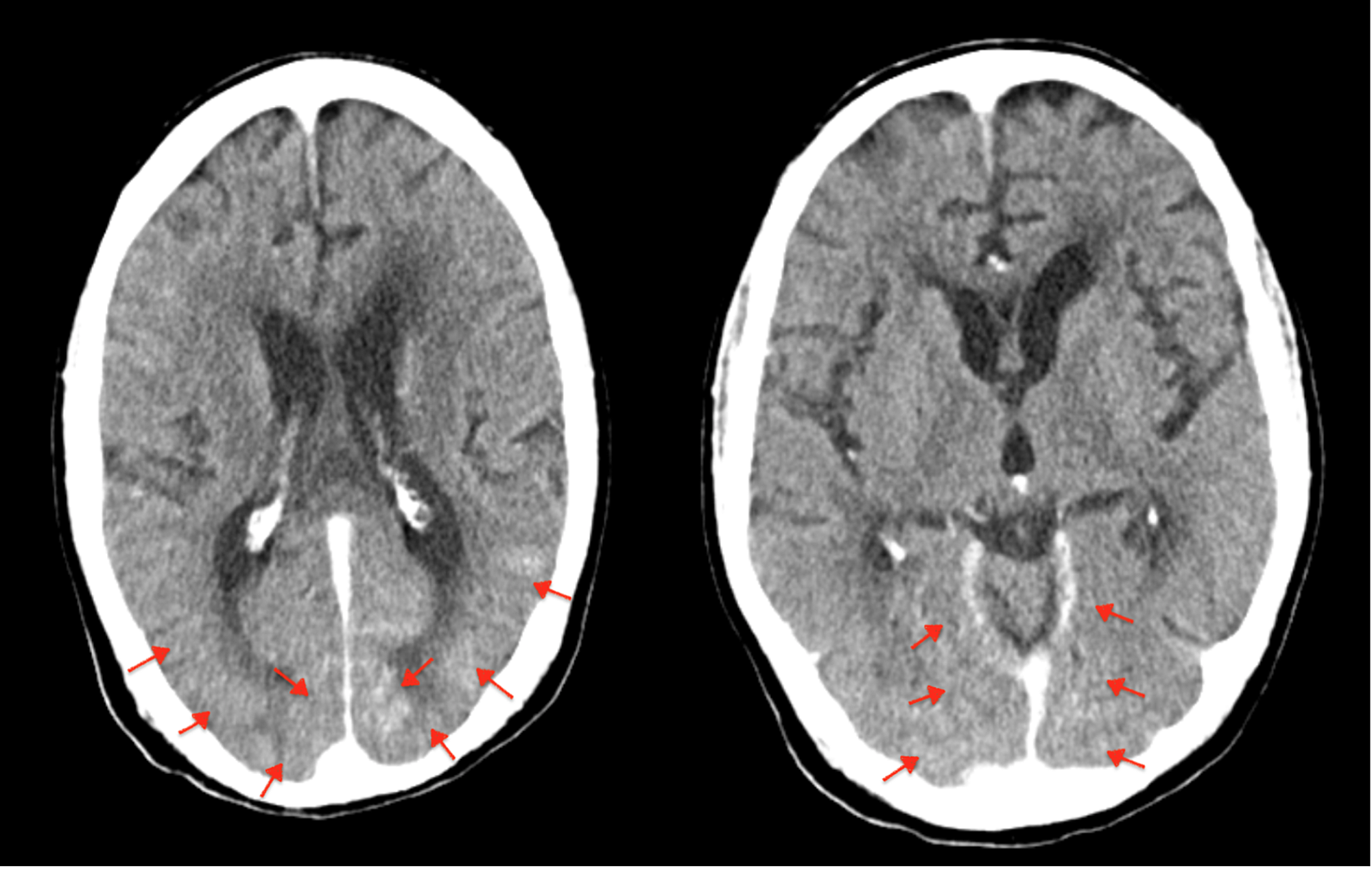 Cureus Contrast Extravasation Mimicking Subarachnoid Hemorrhage After