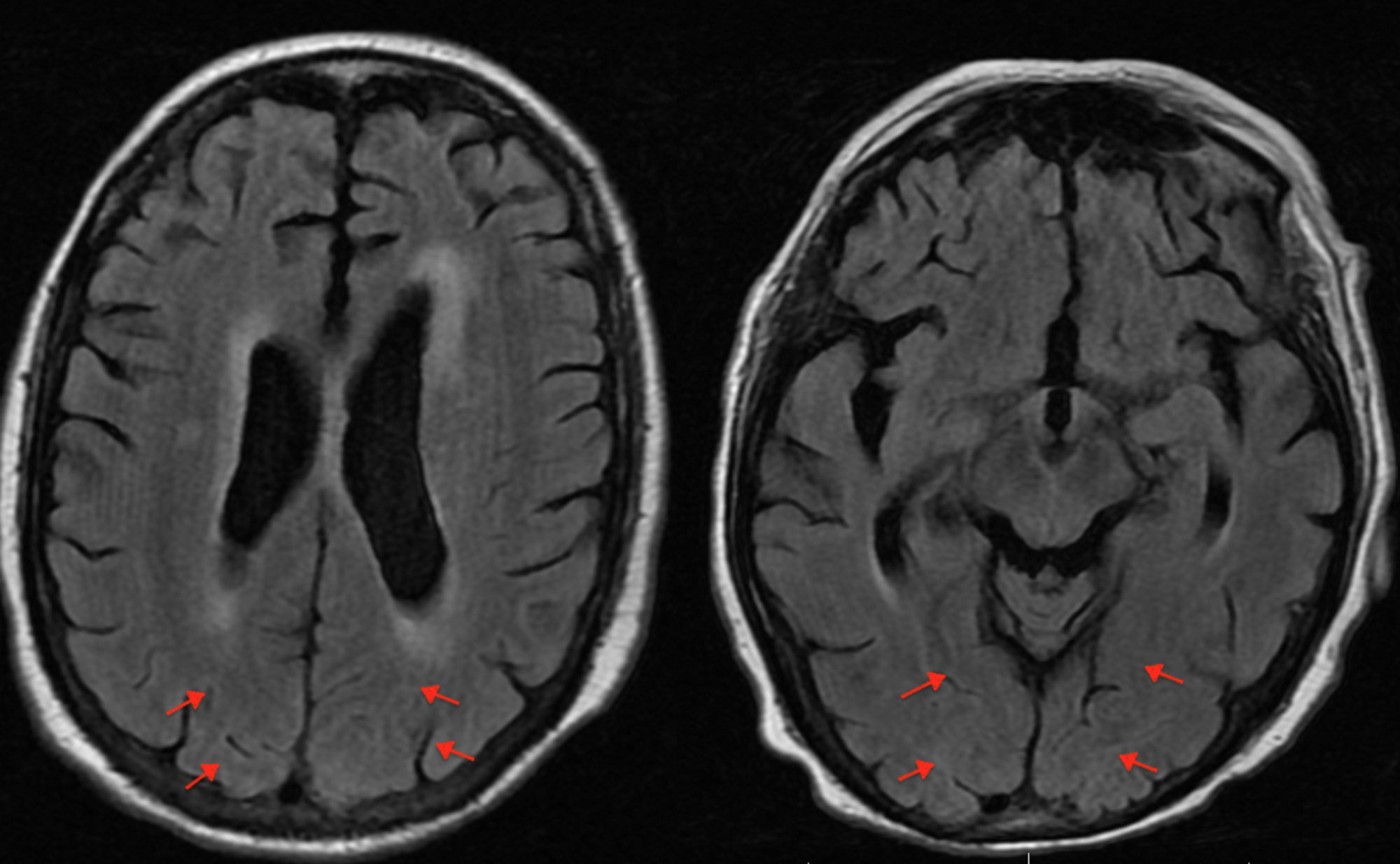 Subarachnoid Hemorrhage Vs Subdural Hematoma Porn Sex Picture