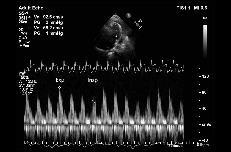 Pulse-wave-Doppler-of-left-ventricular-inflow-on-transthoracic-echocardiogram-(TTE)