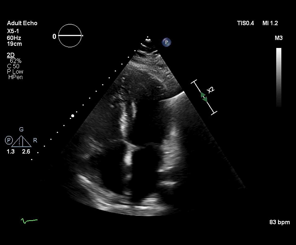 Cureus | Acute Effusive Pericarditis: A Late Complication of COVID-19