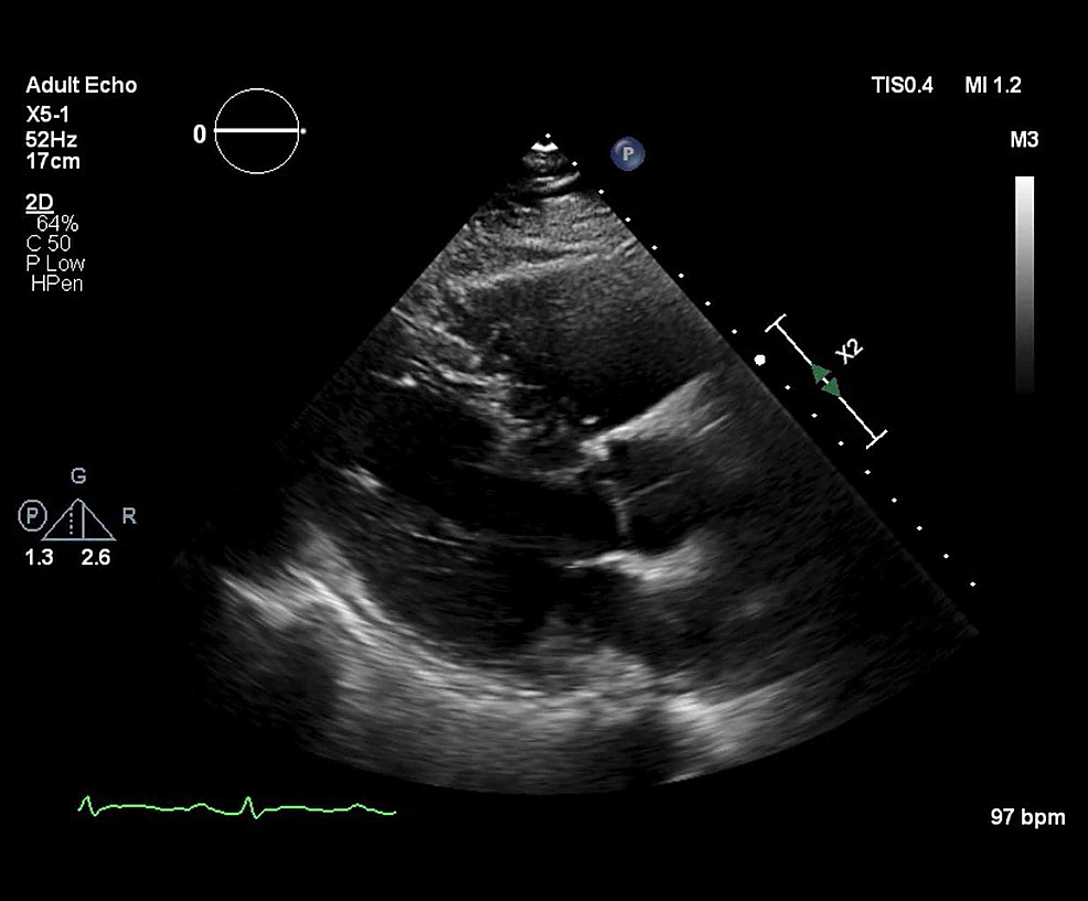 Parasternal-long-axis-view-on-transthoracic-echocardiogram-(TTE)-at-one-month-post-discharge