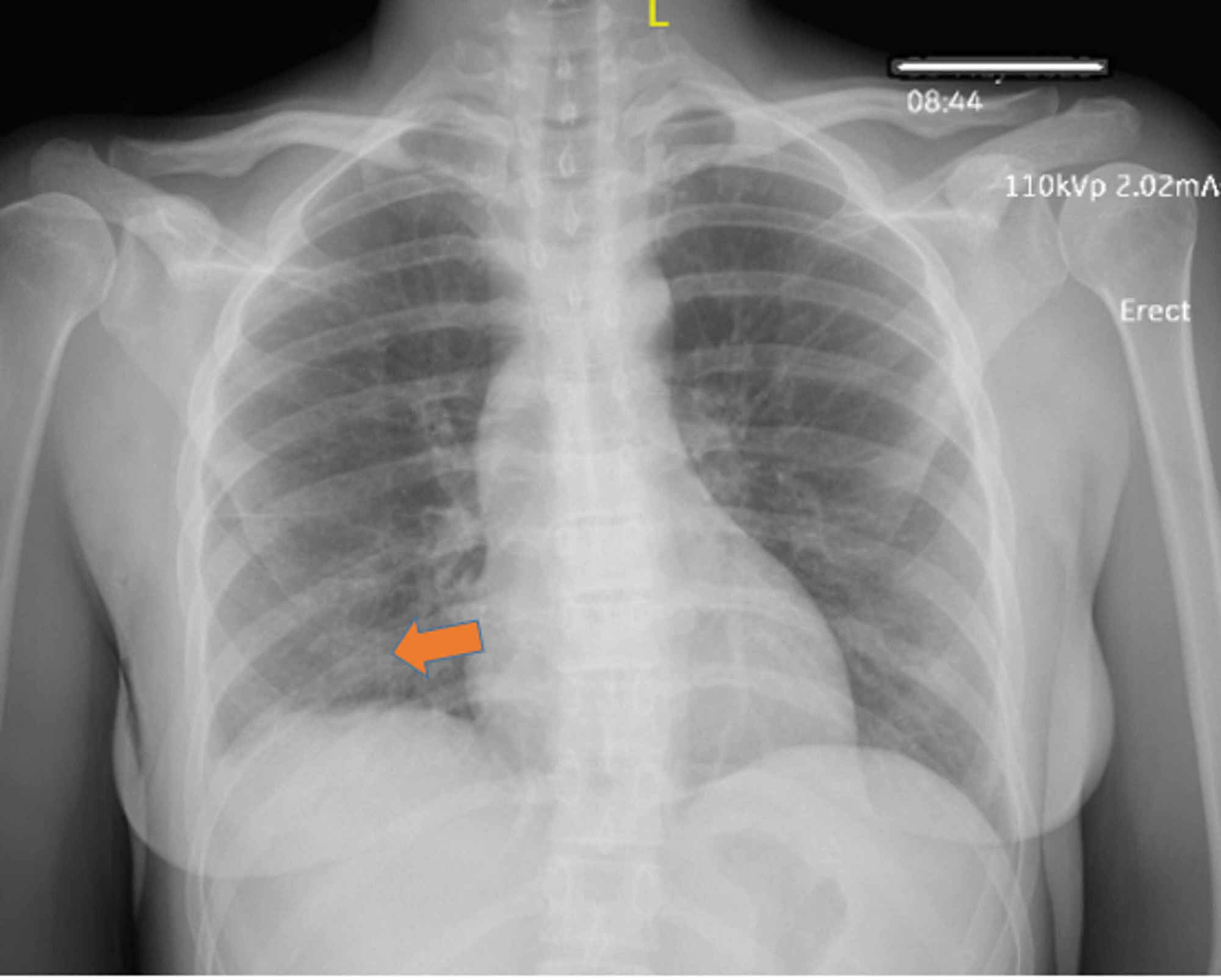 Cureus A Rare Case Of Subacute Painful Thyroiditis Causing Thyroid Storm And A Successful Trial Of Propylthiouracil