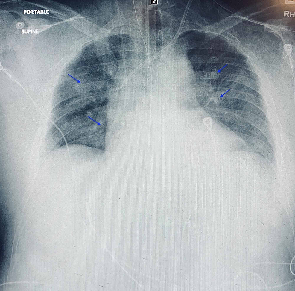 Chest-radiograph-demonstrating-mild-bilateral-perihilar-airspace-opacities-(arrows)