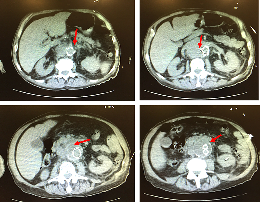 Noncontrast-CT-scan-demonstrating-false-lumen-of-abdominal-aortic-aneurysm-(red-arrows).
