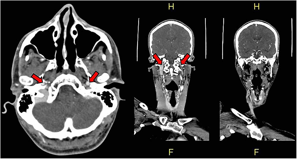 Spontaneous Bilateral Vertebral Artery Dissections Case Report And Hot Sex Picture 7954
