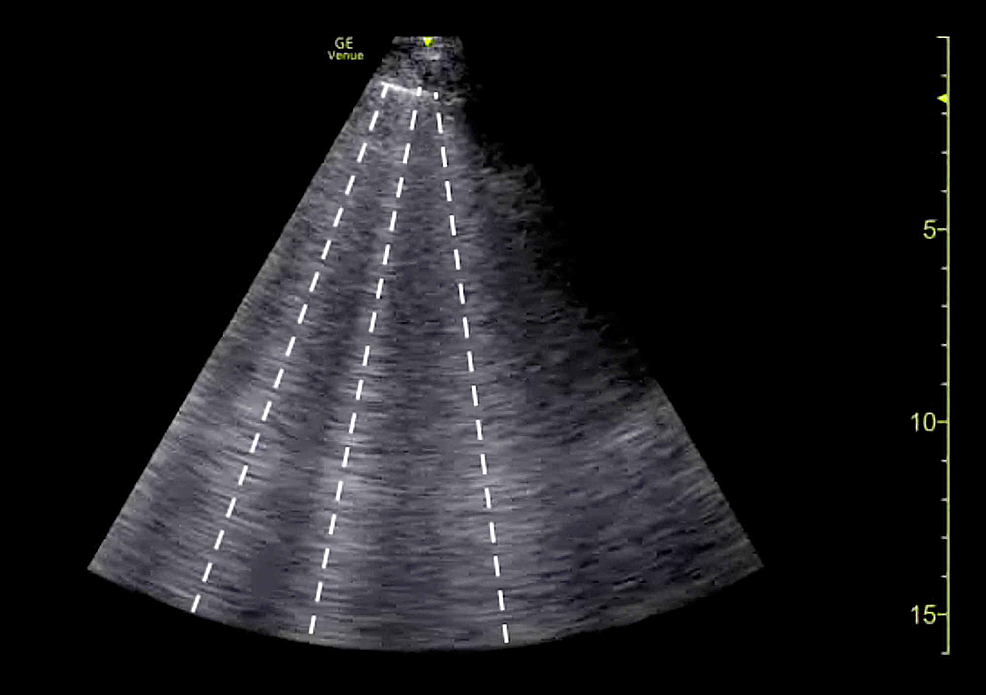 Point-of-care-lung-ultrasound-demonstrating-a-B-line-profile-(white-lines).-