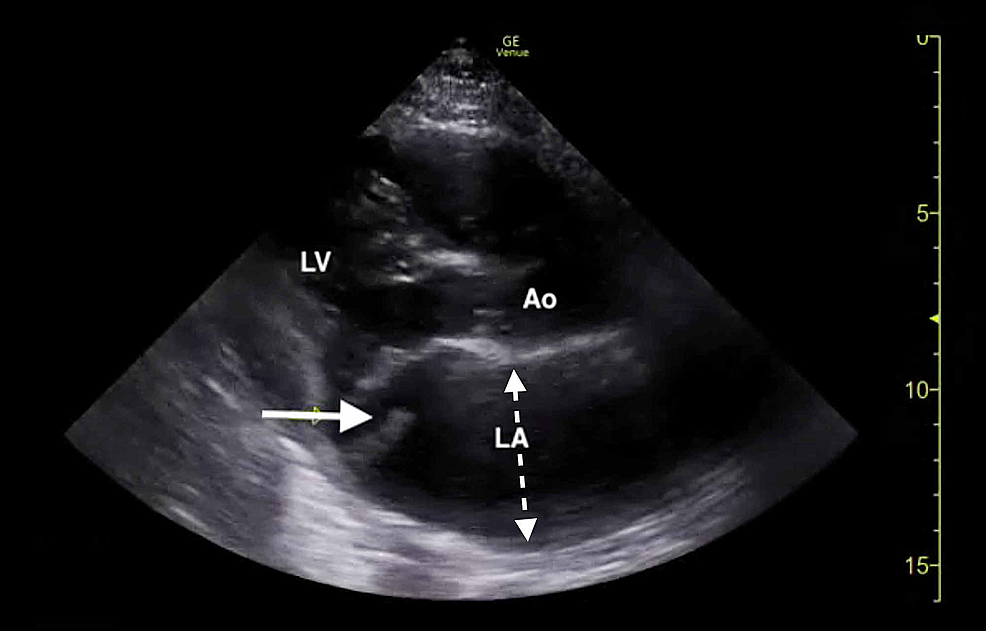 Bedside-transthoracic-echocardiogram-(parasternal-long-axis-window)-demonstrating-a-flail-posterior-mitral-leaflet-(solid-arrow)-and-left-atrial-dilation-(dotted-arrow).-