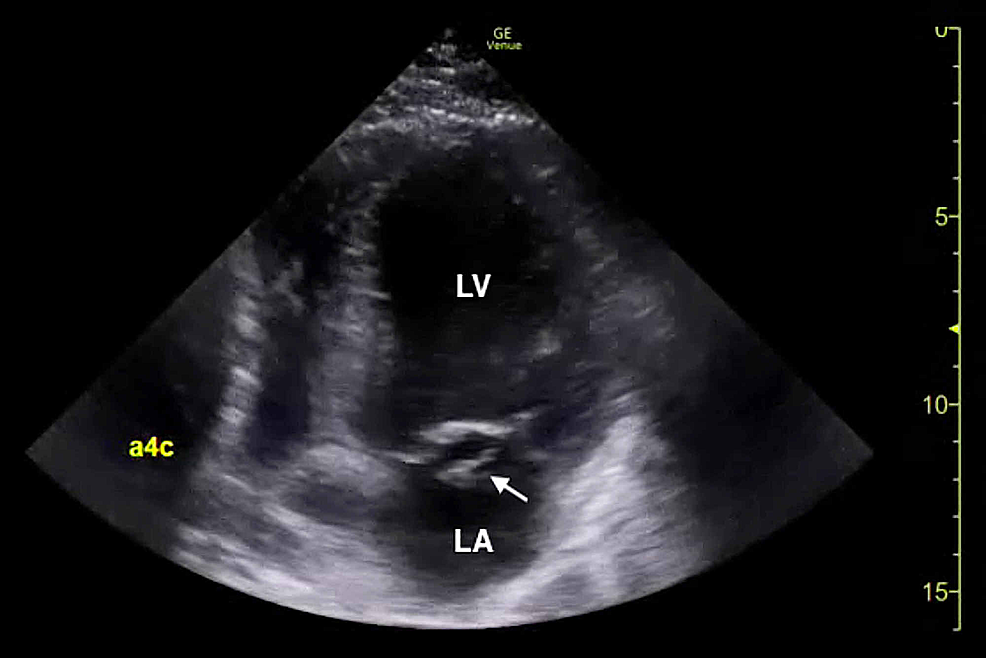 Bedside-transthoracic-echocardiogram-(apical-window)-demonstrating-a-flail-posterior-mitral-leaflet-(arrow).-