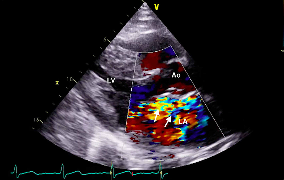 Comprehensive-transthoracic-echocardiogram-(parasternal-long-axis-window)-with-color-Doppler-demonstrating-flail-motion-of-the-posterior-mitral-leaflet-and-a-severe-eccentric-mitral-regurgitant-jet-(arrows).-