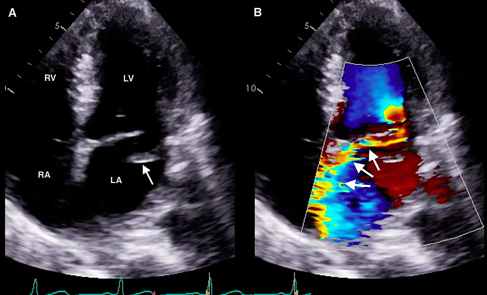 Cureus | Emergent Diagnosis of a Flail Mitral Leaflet With Bedside ...