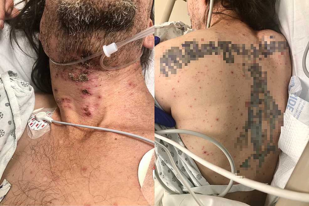 Vesicular-pustular-rash-in-different-stages-of-healing-seen-on-the-neck-(left)-and-back-(right).