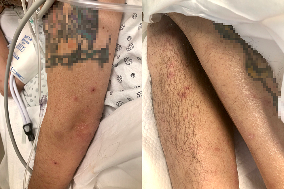 Vesicular-pustular-rash-in-different-stages-of-healing-seen-on-the-left-arm-(left)-and-both-legs-(right).