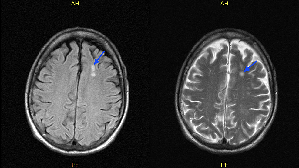 MRI-brain-without-contrast-showing-nonspecific-white-matter-lesions-in-the-high-left-frontal-lobe-measuring-approximately-8-mm-(blue-arrow).