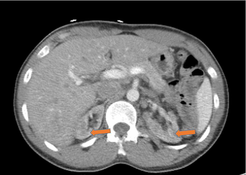 CT-of-the-abdomen-and-pelvis-without-intravenous-contrast-in-an-axial-view-showing-bilateral-renal-atrophy,-without-any-evidence-of-hydronephrosis,-pyelonephritis,-renal-mass,-or-vascular-abnormality.