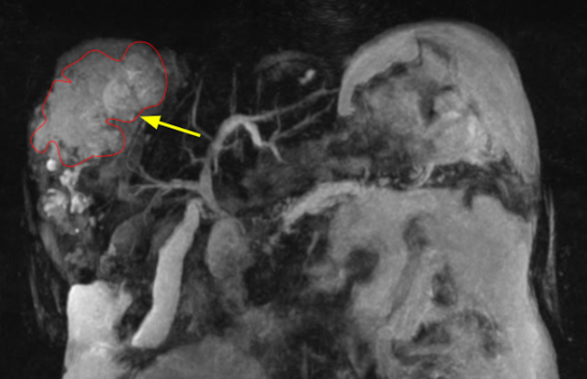 Cureus A Case of Candidal Infection of Large Biloma After CTGuided