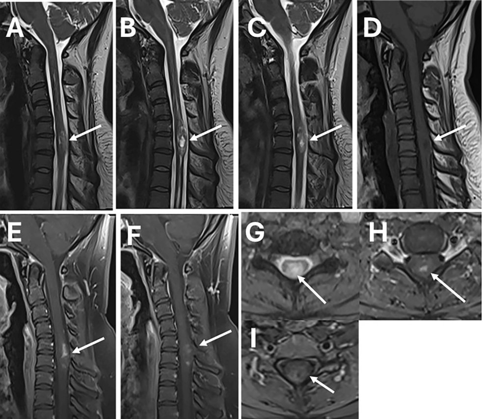 intramedullary melanotic schwannoma A Rare Case of Aggressive Occurred in Spinal Nerve of a 59-Year-Old Male A: MRI study with sagittal