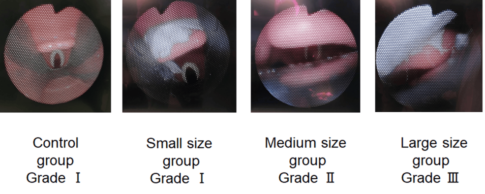 Cormack–Lehane-classification-grade-according-to-the-view-of-the-vocal-cords-observed-using-a-bronchoscope-inserted-through-the-tip-of-the-cuff-and-the-typical-view-of-the-larynx-in-each-group.