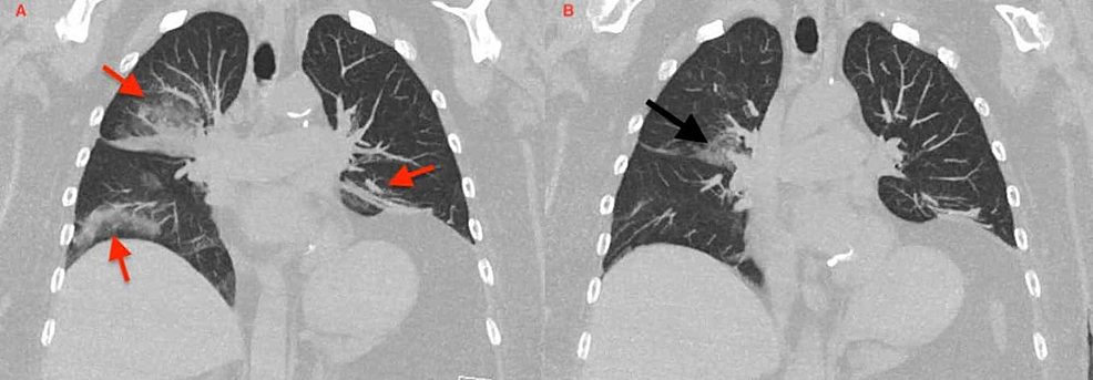 Follow-up-CT-Chest-at-three-months-(panel-A)-showed-partial-improvement-of-bilateral-consolidative-opacities-(red-arrows).-Follow-up-CT-at-six-months-(panel-B)-showing-complete-resolution-of-RUL,-improved-bilateral-lower-lobes-airspace-opacities,-and-a-patchy-consolidative-opacity-in-right-middle-lower-lobe-(black-arrow)-secondary-to-resolving-ELP