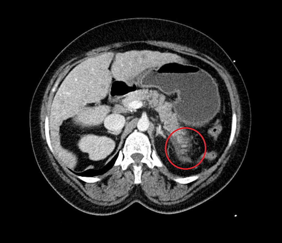 Computed-tomography-(CT)-of-abdomen-showing-fat-stranding-surrounding-the-pancreatic-tail-(red-circle)-consistent-with-acute-pancreatitis.