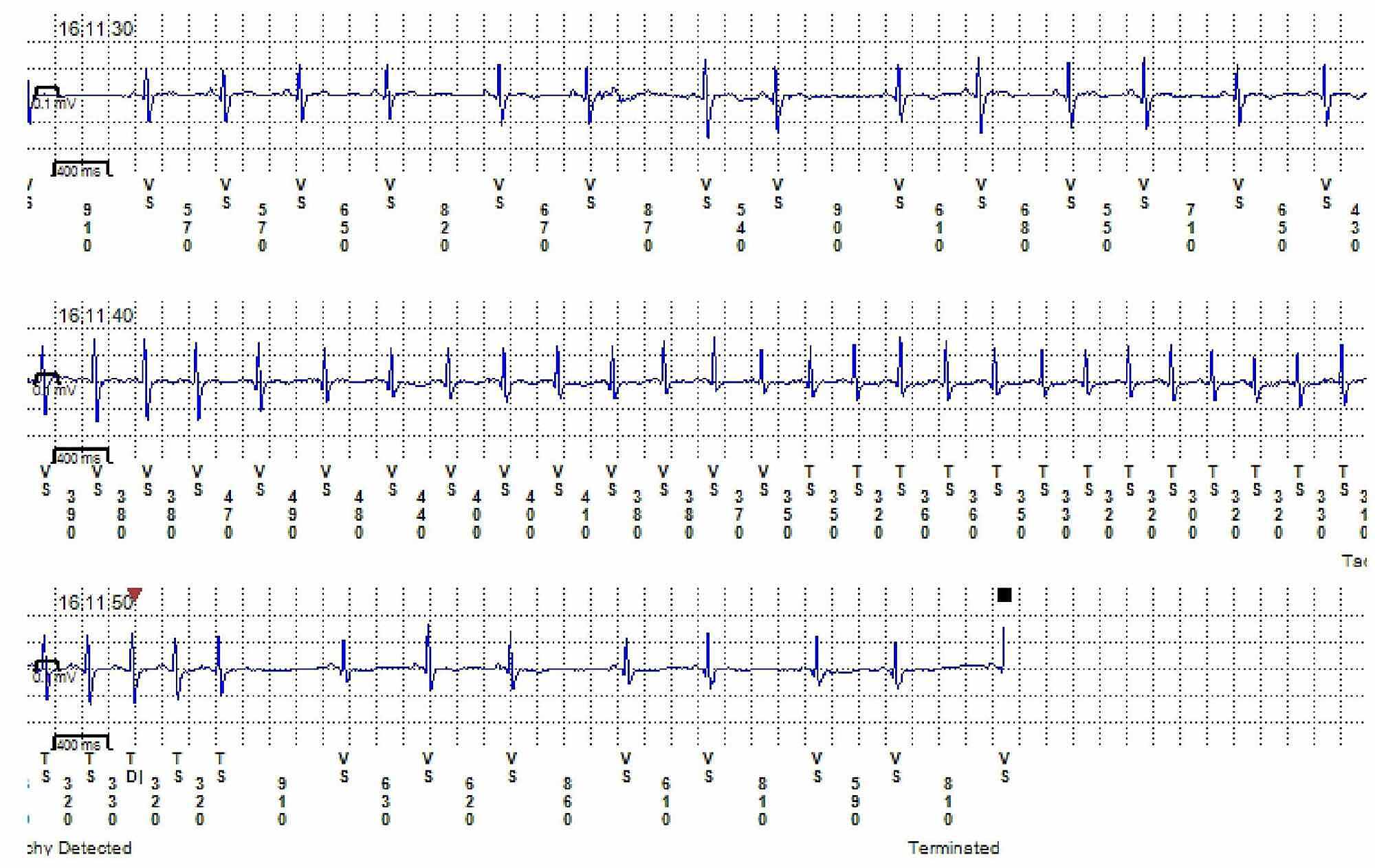 typical atrial flutter icd 10