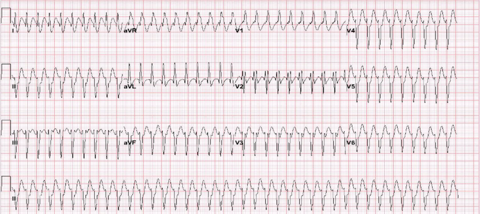 verapamil iv dose for svt