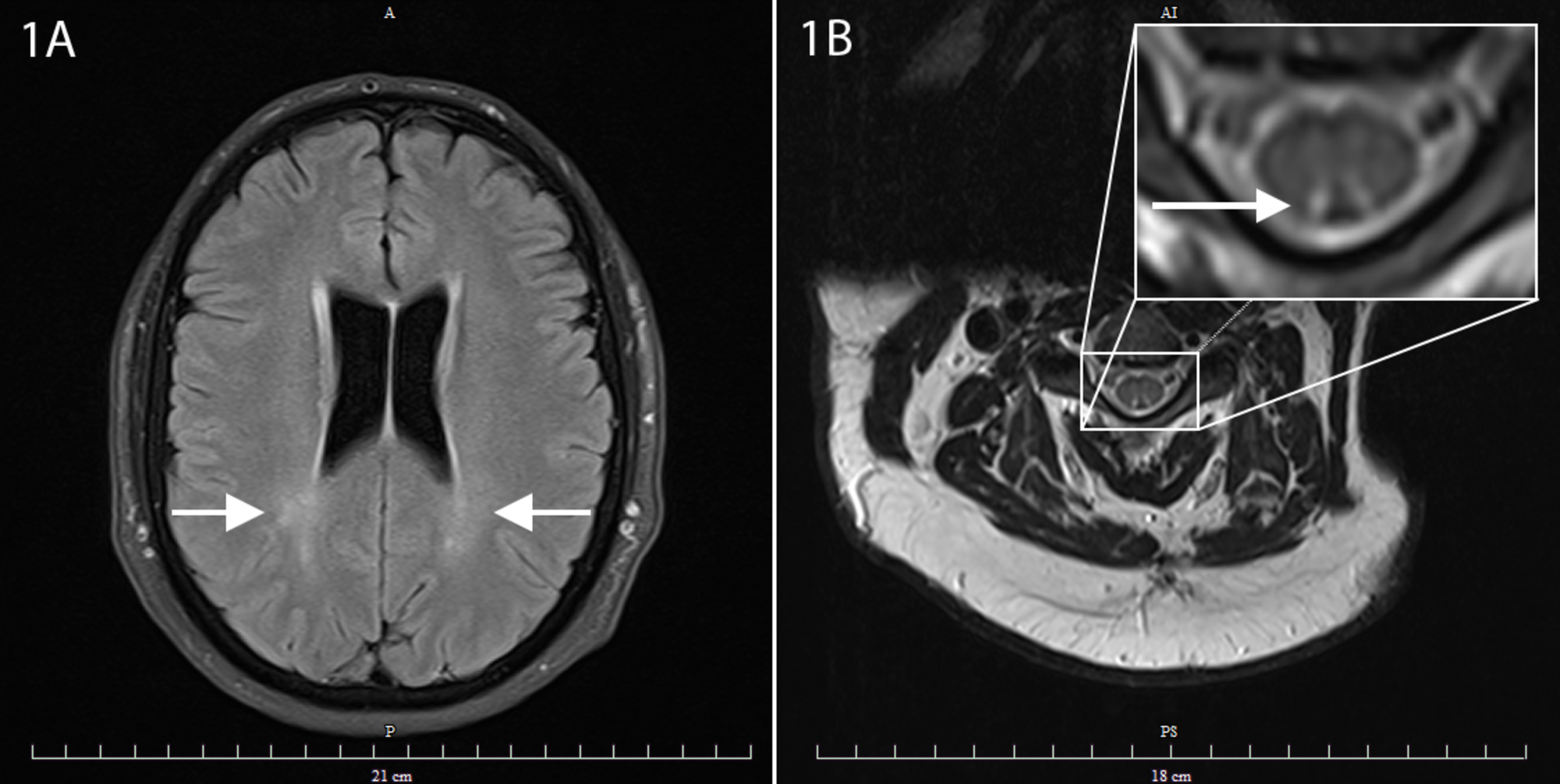 Cureus Nitrous Oxide Induced Posterior Cord Myelopathy Beware of the
