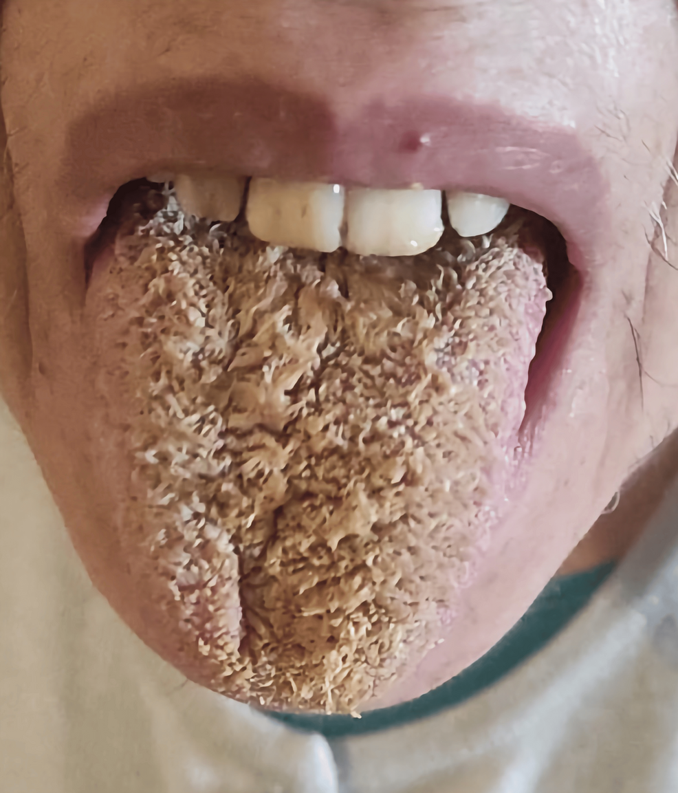 melanotic tongue Oral pigmentation in children: a diagnostic challenge main image 1