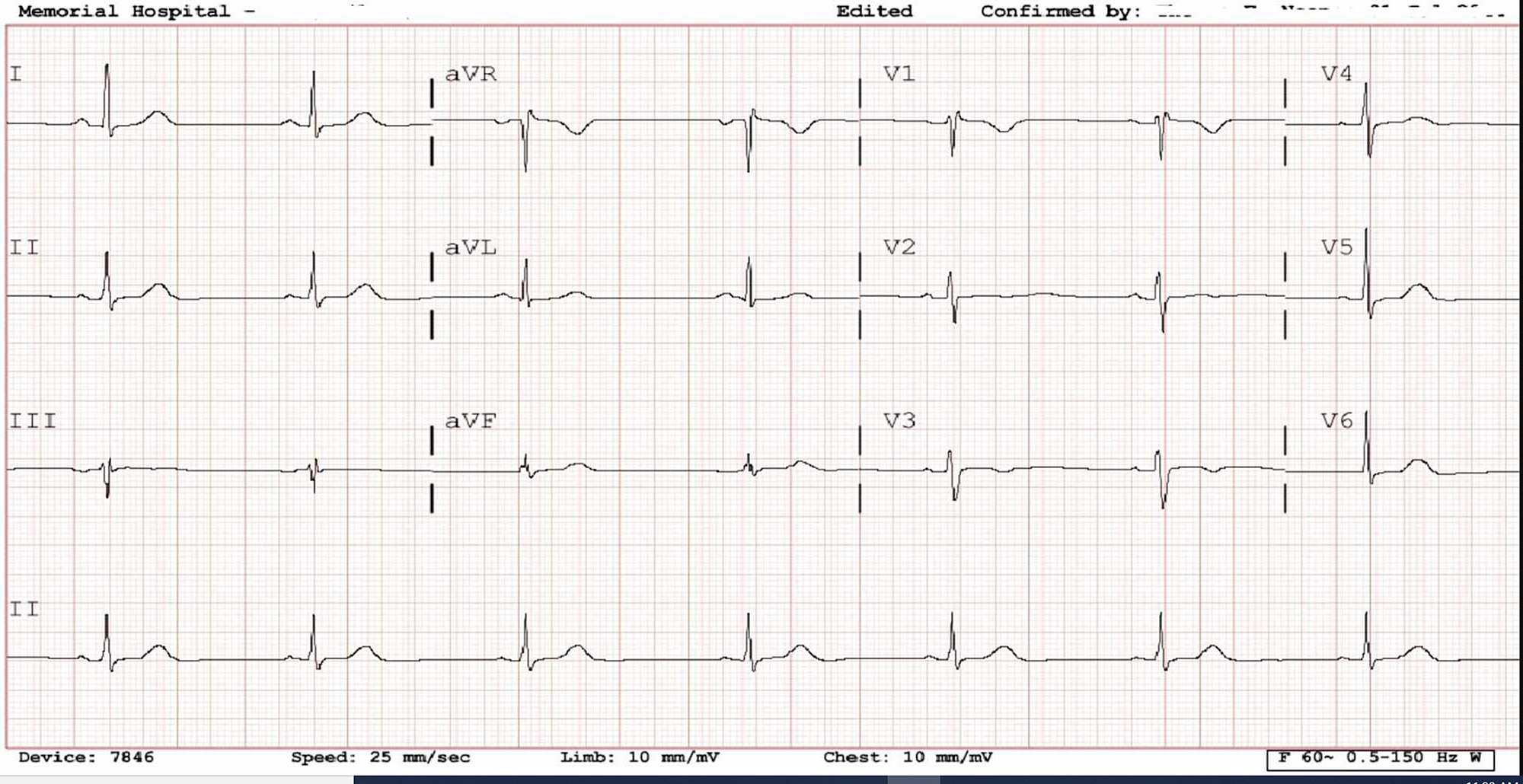 Cureus Postpartum Transient Hypervagotonic Sinus Node Dysfunction Leading To Sinus Bradycardia A Case Report