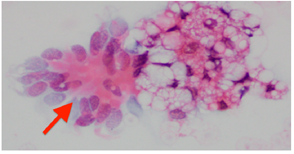 Cytological-findings-of-the-BAL-showing-lipid-laden-macrophages-(red-arrow)-