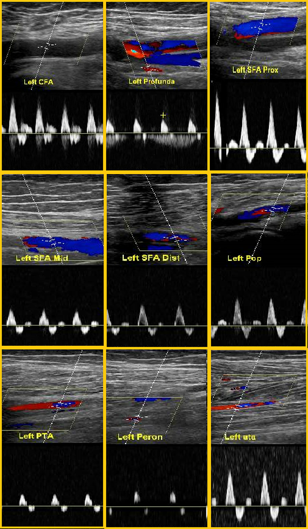 Cureus | Acute Limb Ischemia in COVID-19 Disease: A Mysterious Coagulopathy