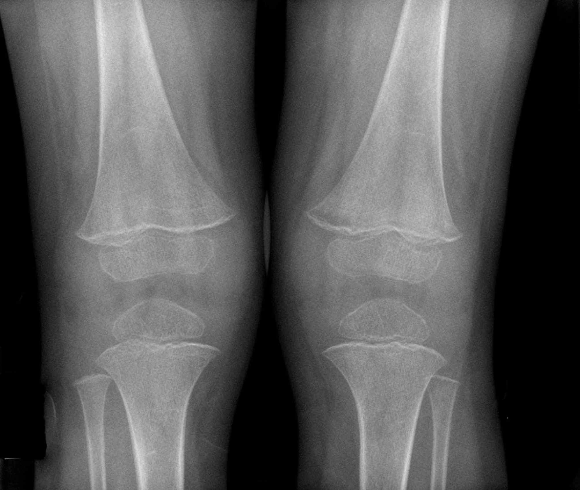 Cureus | Vitamin C Deficiency Presenting as an Acute Limp in Childhood