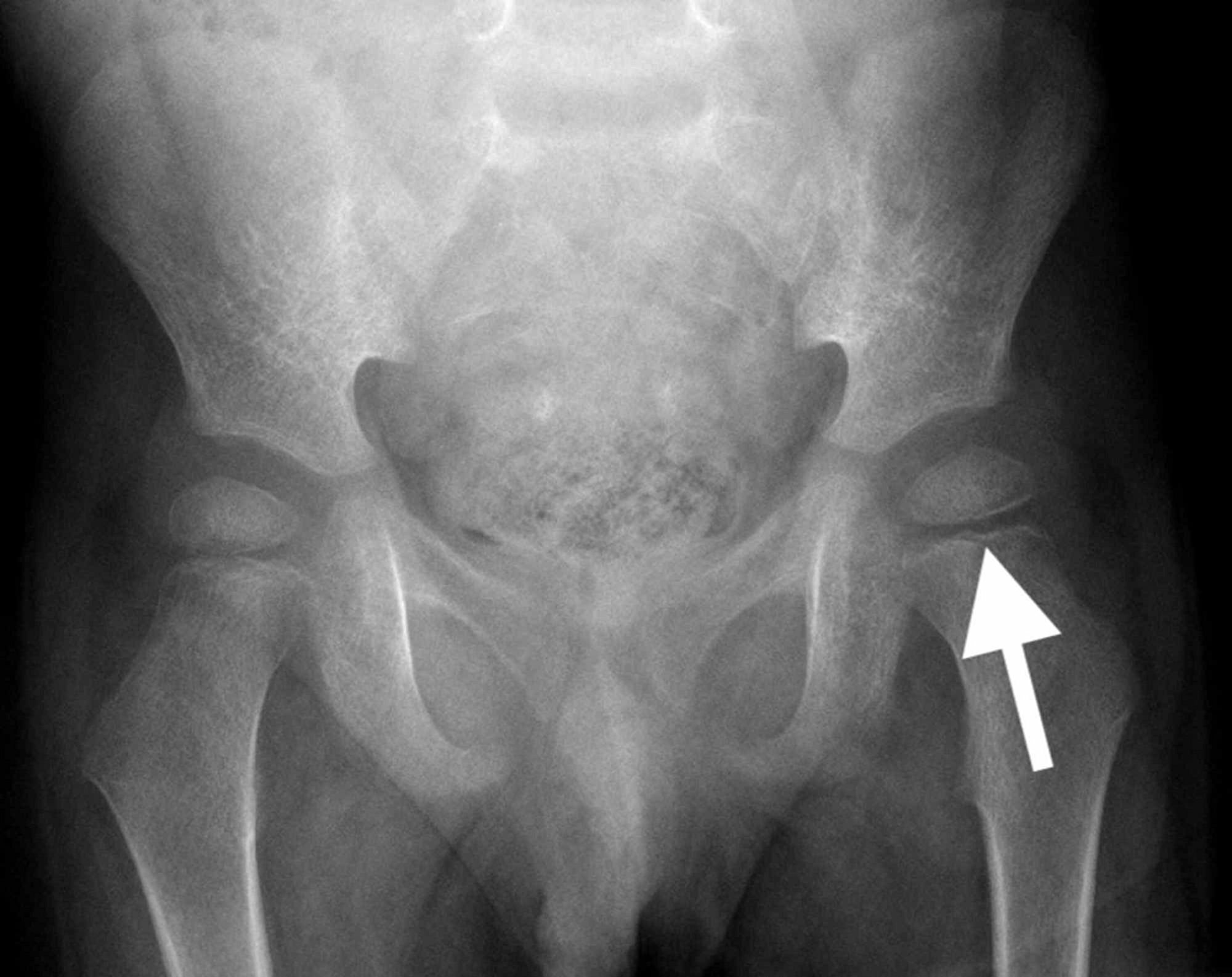 Cureus Vitamin C Deficiency Presenting as an Acute Limp in Childhood
