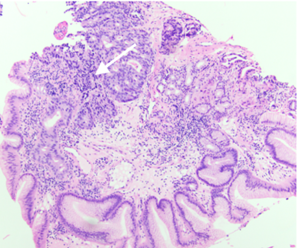 Cureus | Adenocarcinoma Arising From a Cervical Esophageal Inlet Patch ...