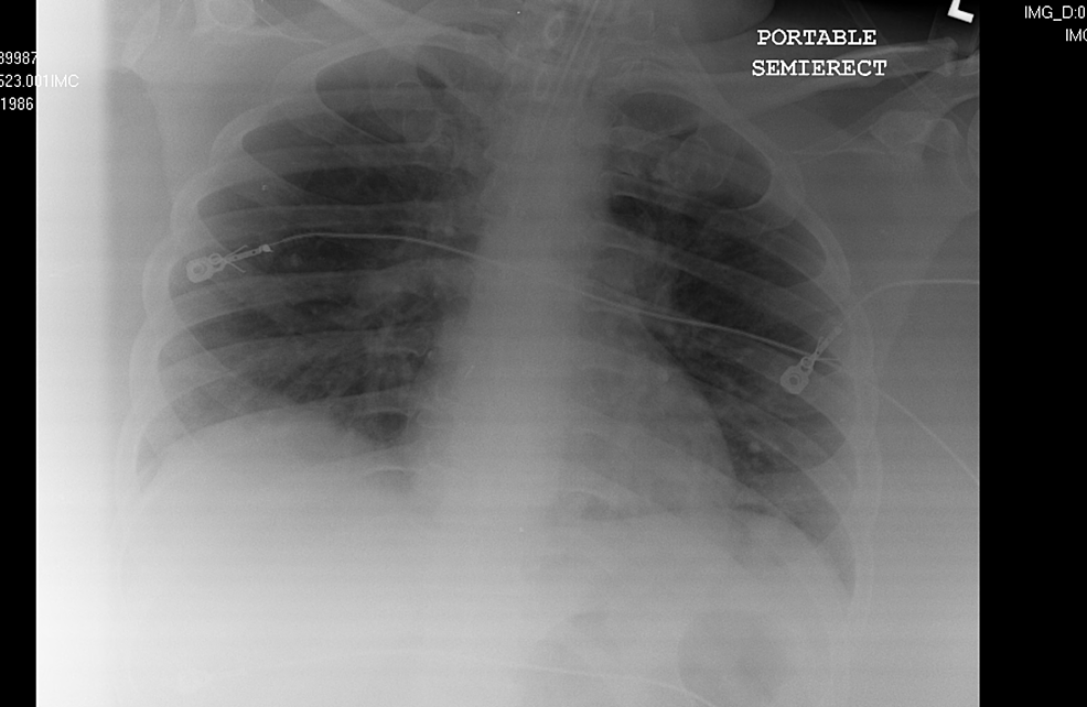 Case-1-chest-X-ray-on-admission-April-11,-2020
