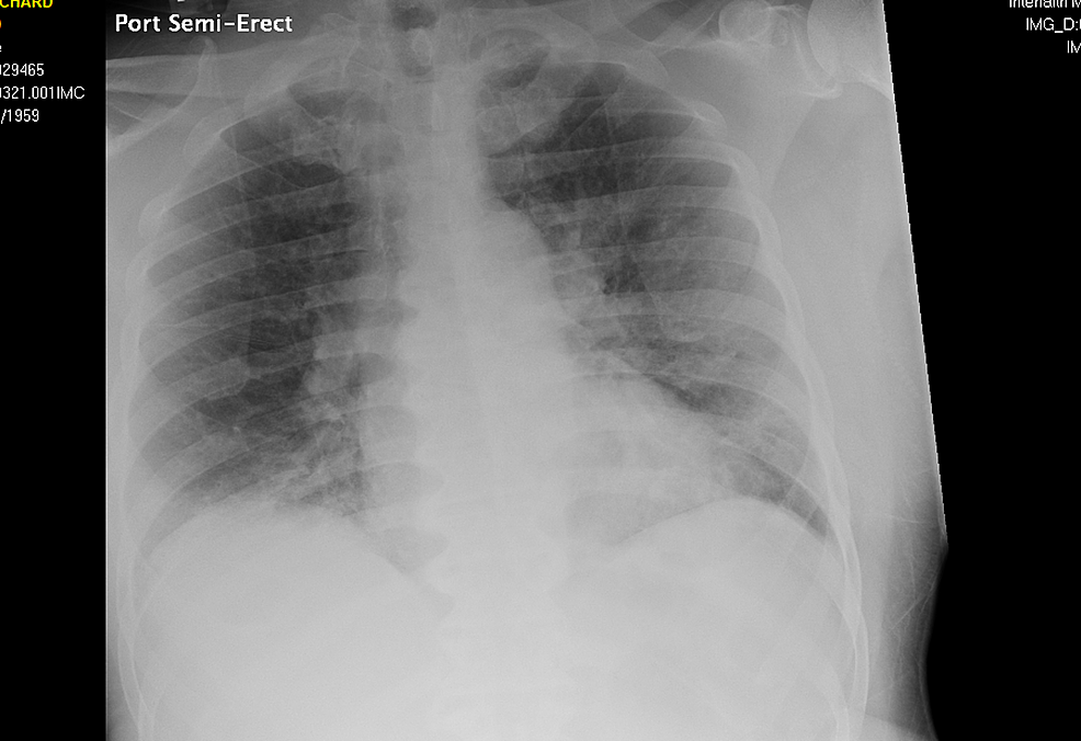 Case-2-chest-X-ray-on-admission-April-03,-2020